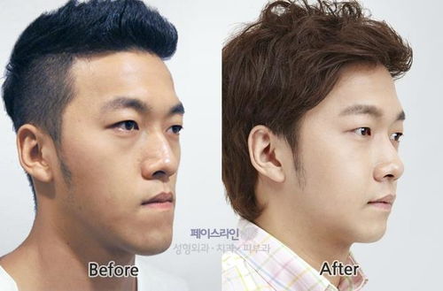 雙額手術(shù)長臉,改善地包天變臉整形手術(shù) 明星手術(shù)怎么做